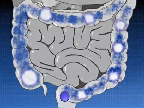 Видео о препарате Салофальк таблетки 500мг 100 шт